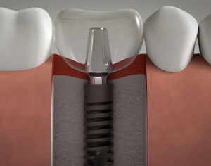 dental implant